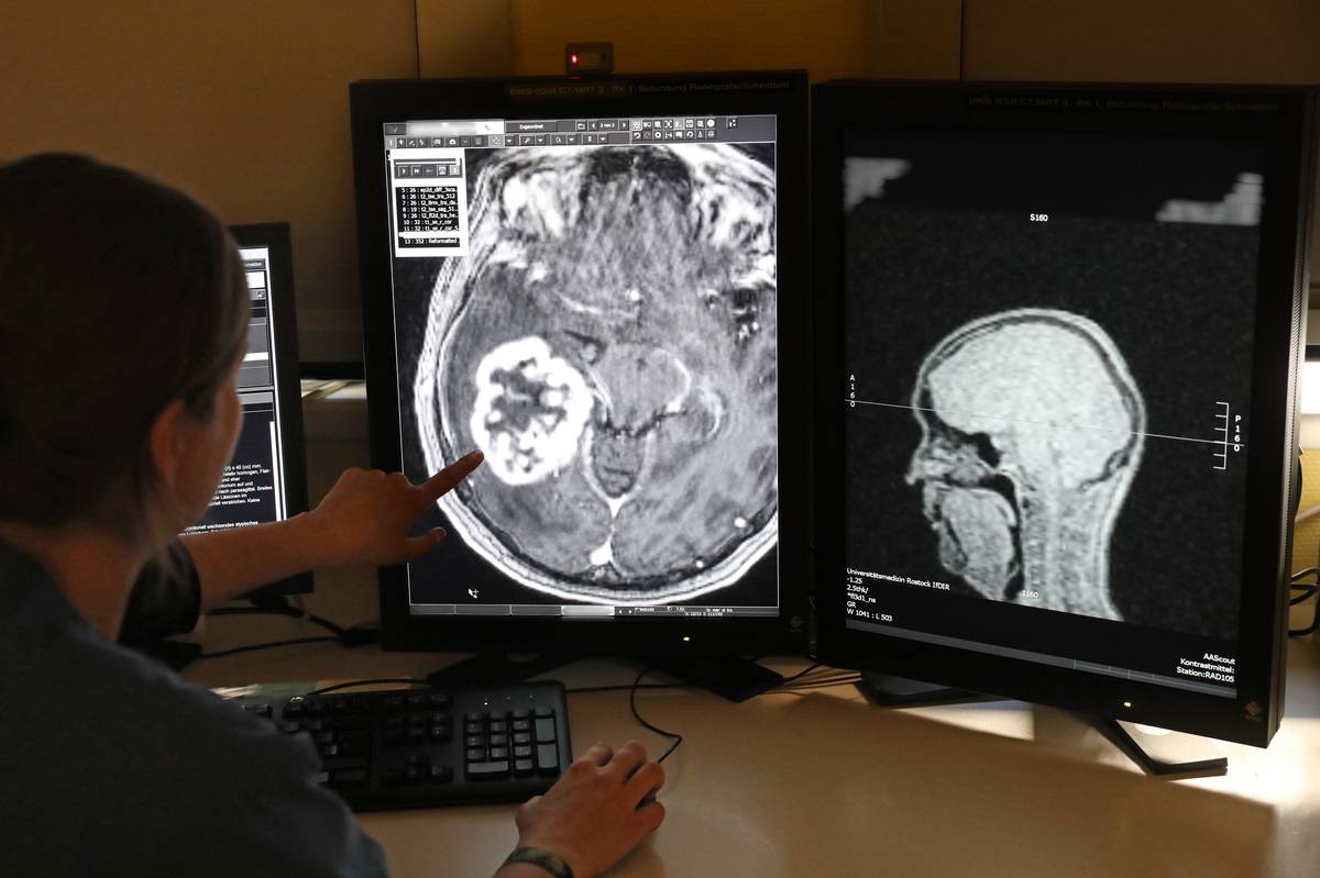 A doctor points at a brain tumor on an MRT scan.